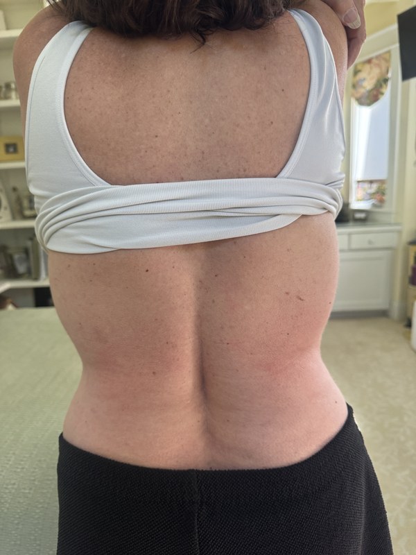 After Cryo Bodyslimming